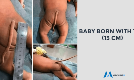 Shocking: Baby Born with a Long Tail of 13cm